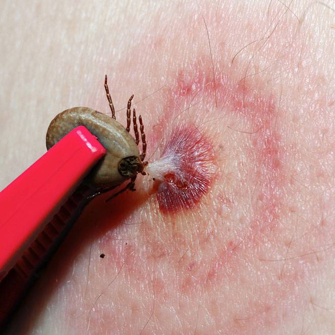 tick bite