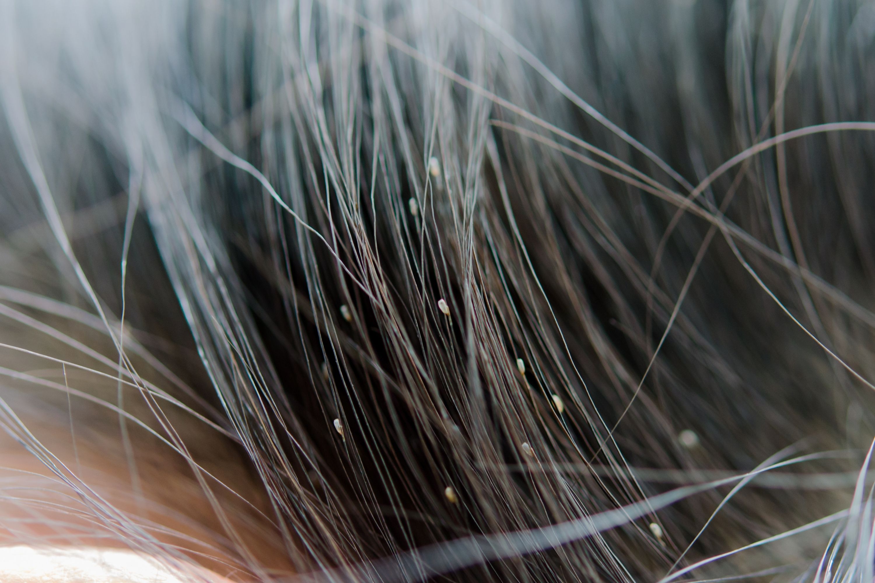 Does Hair Dye Kill Lice? Nits And Eggs Detailed Guide Beezzly