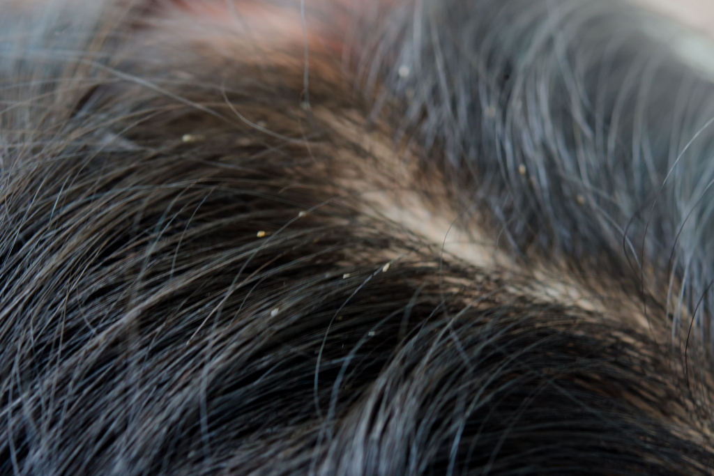 Does Hair Dye Kill Lice? Nits And Eggs Detailed Guide - Beezzly