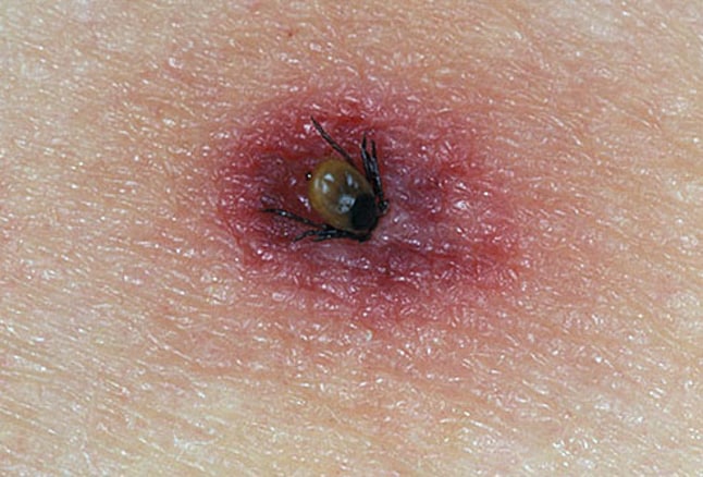 photo of tick burrowing in skin