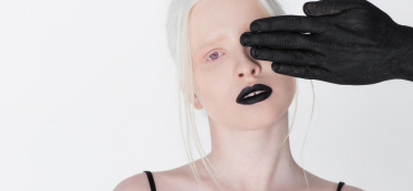 Can Albino People Dye Their Hair