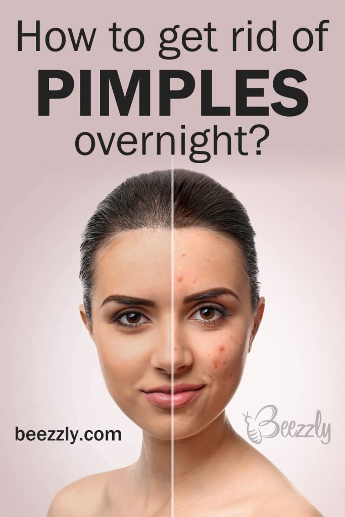 pimples-cheek-pimples-treatment-herzindagi