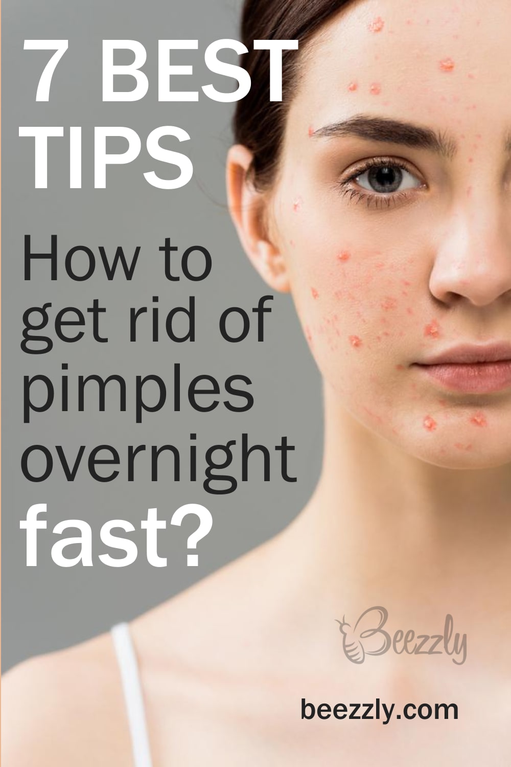 How to Get Rid of Pimples Overnight Fast