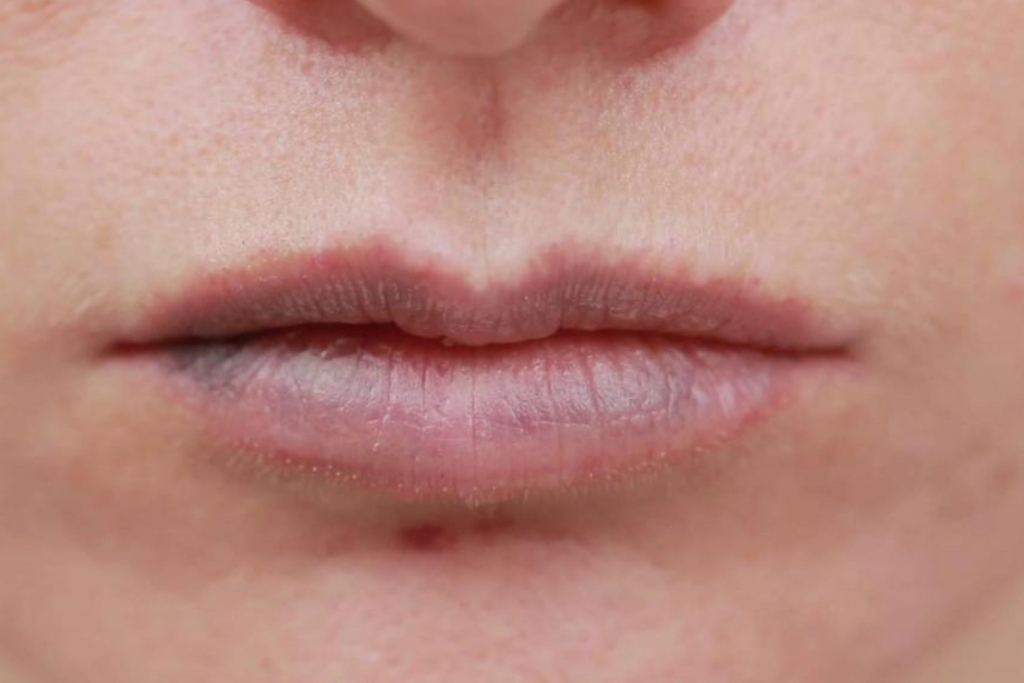 Bruised Lips from Kissing: Top Tips to Avoid It Next Time! - Beezzly