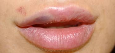 Bruised Lips from Kissing Top Tips to Avoid It Next Time!