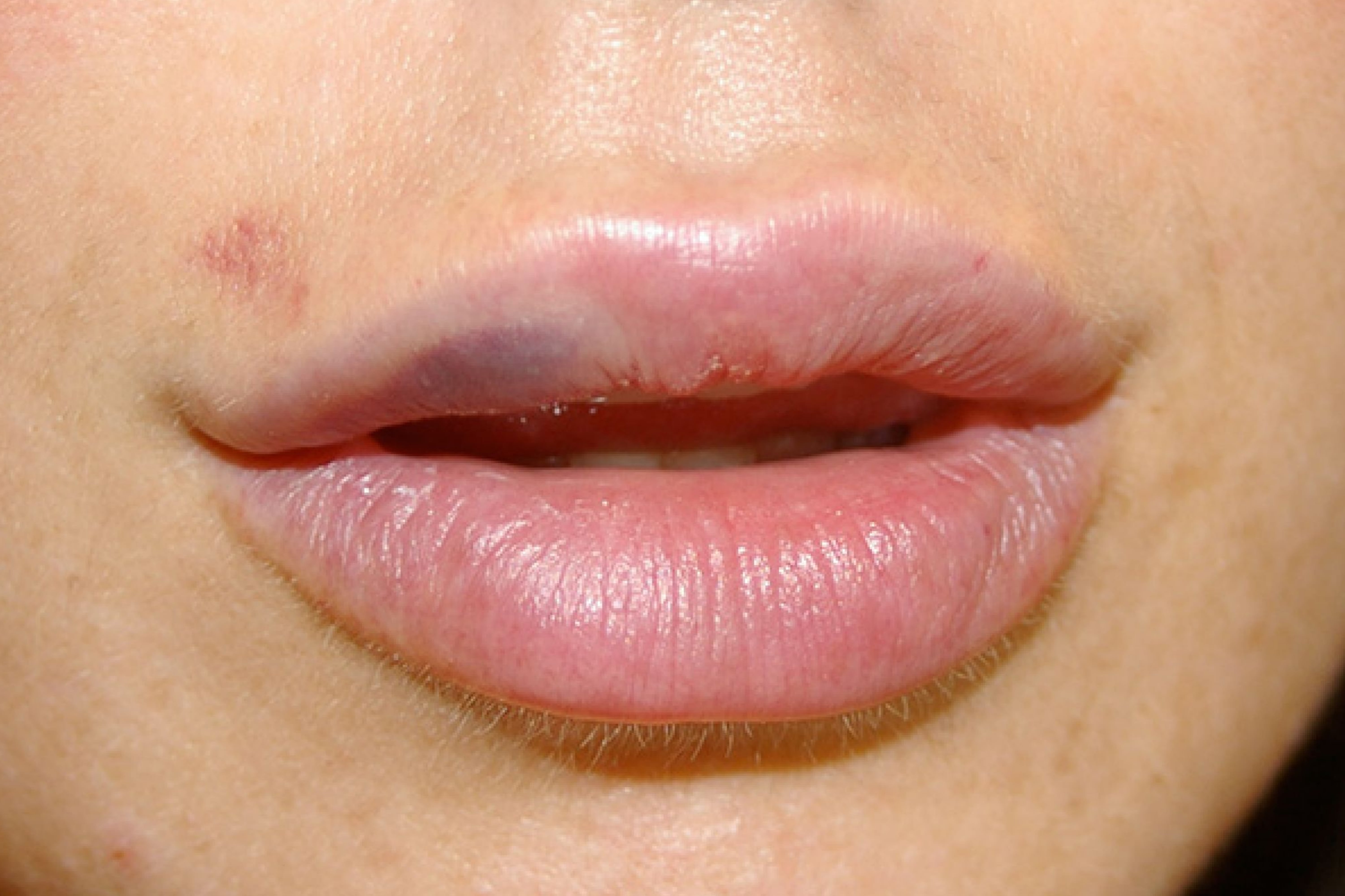 Bruised Lips from Kissing Top Tips to Avoid It Next Time!