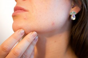 A close-up of acne-prone skin.