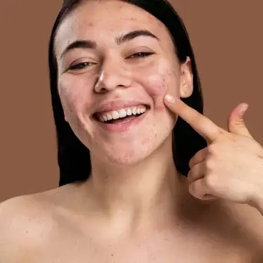 how long does skin purging last