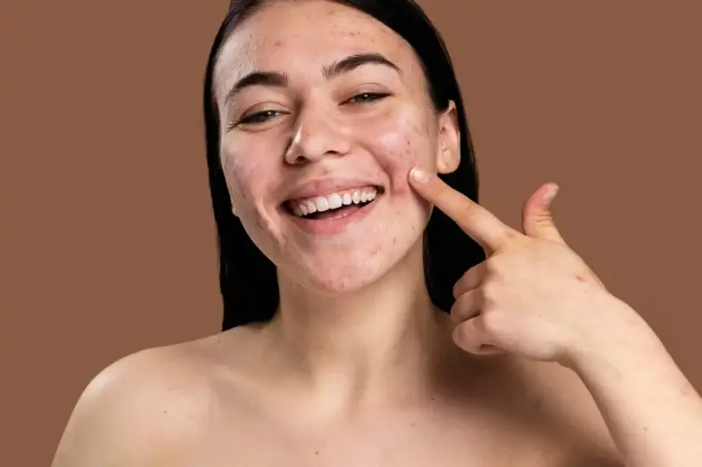 how long does skin purging last